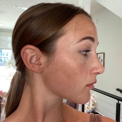 Dallas Rhinoplasty Center: C. Spencer Cochran MD - 2 months post op