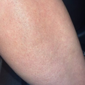 Sodo Nail Lash Bar - The hives and allergic reaction - Eyelash Service Near Me - Orlando, Florida
