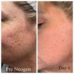 Medically Aesthetically You - Neogen Client with acne scars and discoloration