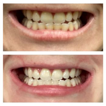 Naturally White Memorial - Before and after - 1 (60 minute) session - Teeth Whitening Near Me - Houston, Texas Naturally White Memorial - Before and after - 1 (60 minute) session - Teeth Whitening Near Me - Houston, Texas