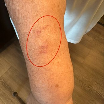 TownePlace Suites Albuquerque North - The bruise the dresser caused on my mom's arm when it fell on her - Hotels Near Me - Albuquerque, New Mexico TownePlace Suites Albuquerque North - The bruise the dresser caused on my mom's arm when it fell on her - Hotels Near Me - Albuquerque, New Mexico