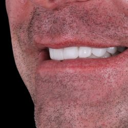 Dental Expressions - Emax All Porcelain Veneers, we accept PPO insurance