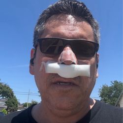 Gary Ford, MD - These are post-op bandages. These are removed after three days.