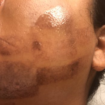 Sculpture Total Skin Care - Burn from laser - Medical Spas Near Me - Richmond, Virginia Sculpture Total Skin Care - Burn from laser - Medical Spas Near Me - Richmond, Virginia