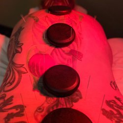 KineticShen Acupuncture - Paraspinal tension release