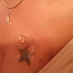 The tattoo. The penny is taped by it to show scale.