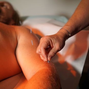 Restorative Acupuncture and Herbs - Acupuncture Near Me - Wilton Manors, Florida Restorative Acupuncture and Herbs - Acupuncture Near Me - Wilton Manors, Florida