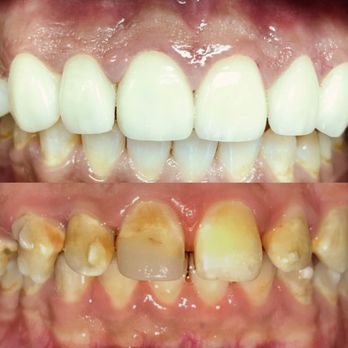 Harmony Dental Group - smile makeover with veneers - Cosmetic Dentists Near Me - La Jolla, California