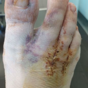 Henry Tseng, DPM - 5 weeks after my right bilateral nerouma surgery - Podiatrists Near Me - West Covina, California Henry Tseng, DPM - 5 weeks after my right bilateral nerouma surgery - Podiatrists Near Me - West Covina, California
