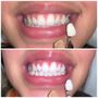 Photo of New Smile Design
