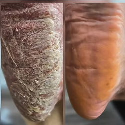 Callus Removal - diabetic and therapeutic foot care