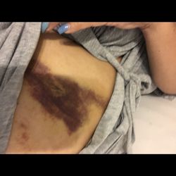 Lixana Vega Vega, MD - Infected and bleeding inside.