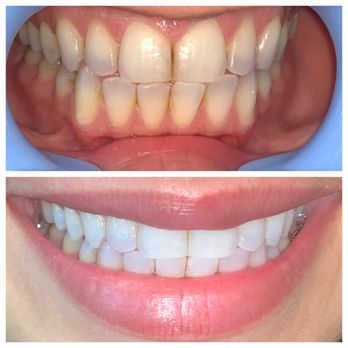 Moe's Teeth Whitening - I'm a chronic coffee drinker, so the results surprised me - Teeth Whitening Near Me - El Cajon, California Moe's Teeth Whitening - I'm a chronic coffee drinker, so the results surprised me - Teeth Whitening Near Me - El Cajon, California