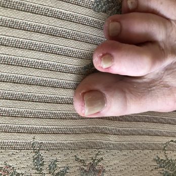 Lily's Nails - Dry skin, uneven too short nails. Redness - Nail Salons Near Me - Mukilteo, Washington