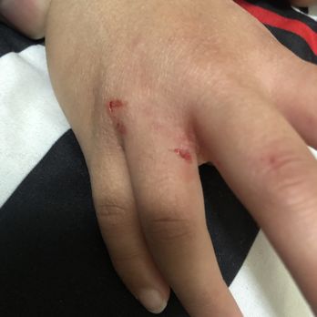 Sugar Pine Doodles - SPD dog bit my 5.5 year old son aggressively on the hand and punctured the skin in ten spots. - Pet Breeders Near Me Sugar Pine Doodles - SPD dog bit my 5.5 year old son aggressively on the hand and punctured the skin in ten spots. - Pet Breeders Near Me