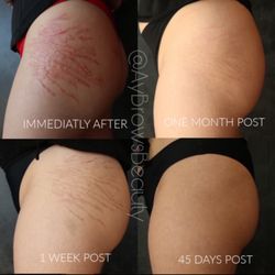 Skin camouflage for stretch marks