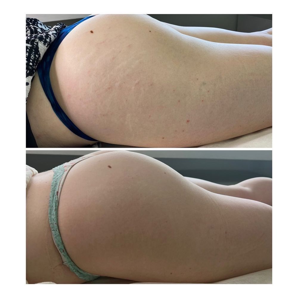 Boleyn studio - Top photo before treatment - Bottom photo is 10 months later (forgot to take a photo immediately after it healed) - Permanent Makeup Near Me - Beverly Hills, California Boleyn studio - Top photo before treatment - Bottom photo is 10 months later (forgot to take a photo immediately after it healed) - Permanent Makeup Near Me - Beverly Hills, California