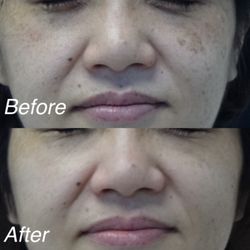 Imperial Facial - Melasma & Spots