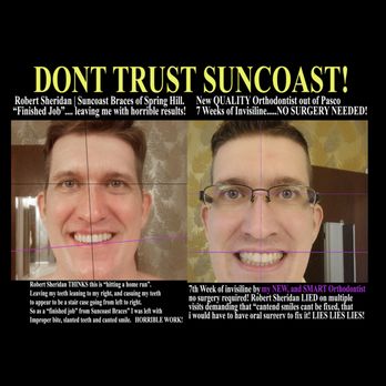 Suncoast Braces - L: Suncoast' "finished job", they claim SURGERY WAS NEEDED to fix slanted smile. R: NEW Orthodontist FIXES in 7 weeks. NO SURGERY NEEDED. - Orthodontists Near Me - Spring Hill, Florida