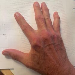 Keith Denkler, MD - Dorsum Right hand