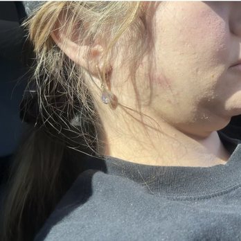 Dolores Kent, MD - 8 month postop. Hideousness. It looks worse! - Obstetricians & Gynecologists Near Me - Los Angeles, California