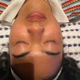 After results of my facial! After results of my facial!