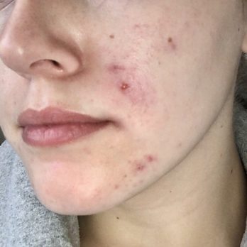 Luxe Laser - Before - Laser Hair Removal Near Me - Portland, Oregon