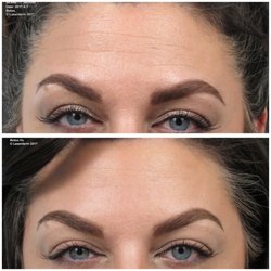Laserderm - Before, two weeks later. :)