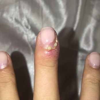 Utopia Nails - two weeks post nails done.. on antibiotics and topical... they might have to remove my finger at this point. DISGUSTED. - Nail Salons Near Me - West Palm Beach, Florida