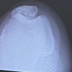 Michael Vercillo, MD - Kneecap before surgery