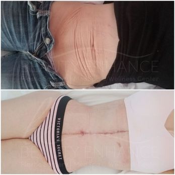 Dr. Carmina Cardenas - Lower Body Lift & Fleur de Lis, Muscle repair, liposuction and fat transfer to buttocks and hips - Cosmetic Surgeons Near Me - Tijuana, BCN Dr. Carmina Cardenas - Lower Body Lift & Fleur de Lis, Muscle repair, liposuction and fat transfer to buttocks and hips - Cosmetic Surgeons Near Me - Tijuana, BCN
