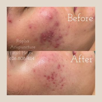 Rapha Acupuncture and Herbs - Acne treatment before and after. - Acupuncture Near Me - Arcadia, California Rapha Acupuncture and Herbs - Acne treatment before and after. - Acupuncture Near Me - Arcadia, California