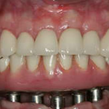 Correct Choice Dental Group - This patient has an inherited birth disorder called Ectodermal Dysplasia. The ectodermal dysplasias involve defects in the hair, - Cosmetic Dentists Near Me - Encinitas, California