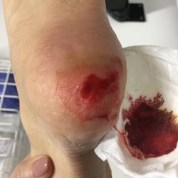 Podiatry HQ - Went in on 26th October for medical pedicure. Left with bleeding heel!! Paid full price $99. Poor management.