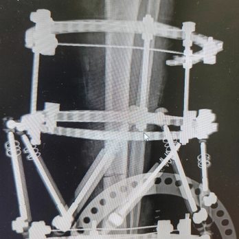 Ibrahim Akkari, DPM - Charcot Reconstructive Surgery Preventing Limb Loss - Podiatrists Near Me - Long Beach, California