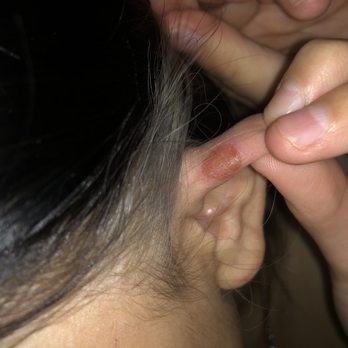 Shadified Salon Spa - chemical burn on ear - Hair Salons Near Me - Edmonton, Alberta Shadified Salon Spa - chemical burn on ear - Hair Salons Near Me - Edmonton, Alberta