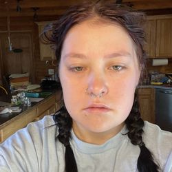 James K Homrighausen, DMD - Luckily no bruising, but left side feels like they broke my jaw, possible nerve damage.