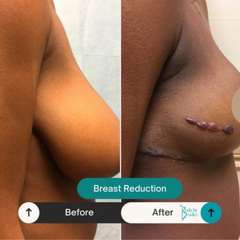 Timothy Bradley, MD - Before & After Breast Reduction 1 week - Cosmetic Surgeons Near Me - Tamarac, Florida Timothy Bradley, MD - Before & After Breast Reduction 1 week - Cosmetic Surgeons Near Me - Tamarac, Florida