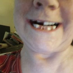 Brueggen Dental Implant Center - Dr. Brueggen thinks his work is fine. Cash paid, years of being in the chair - for this.