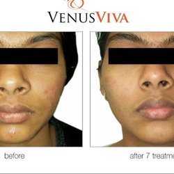Renati Med Spa - Do you have acne, acne scar, injury scars, un even skin? Try our Venus Viva treatment!!
Call now for an appointment