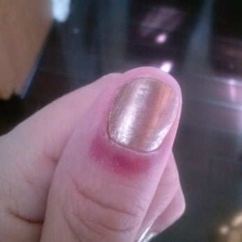 Love Nails - Infection I recieved from Love Nails in Chino, CA. (01.28.16) - Nail Technicians Near Me - Chino, California Love Nails - Infection I recieved from Love Nails in Chino, CA. (01.28.16) - Nail Technicians Near Me - Chino, California