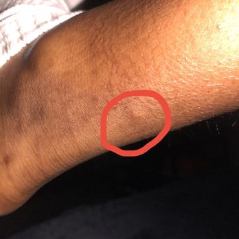 Queen Anne Hotel - BED BUG BITE - Hotels Near Me - San Francisco, California Queen Anne Hotel - BED BUG BITE - Hotels Near Me - San Francisco, California