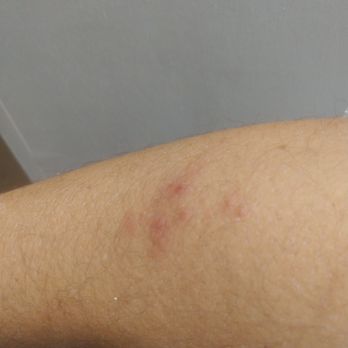 Courtyard by Marriott St. Augustine Beach - About 10 Bites on this spot on my arm.  It swole up. - Hotels Near Me - St. Augustine, Florida