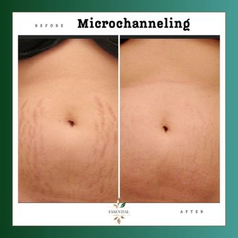 Essential  - Microchanneling for stretchmarks - Permanent Makeup Near Me - Land O' Lakes, Florida