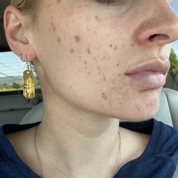 Skincare by Carla - Vi chemical peel - Estheticians Near Me - San Mateo, California Skincare by Carla - Vi chemical peel - Estheticians Near Me - San Mateo, California