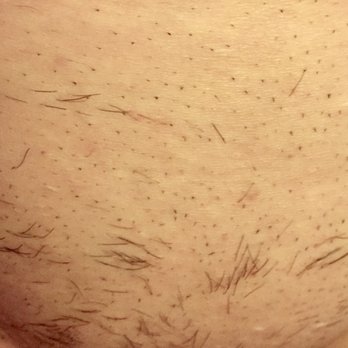 LaserAway - Tattoo Removal Near Me - San Francisco, California LaserAway - Tattoo Removal Near Me - San Francisco, California