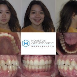 Houston Orthodontic Specialists - Bellaire - After