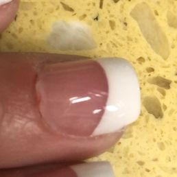 Cuticles bleeding - A fingernail with a French manicure, featuring a white tip and natural pink base, is shown against a yellow textured background.