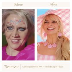 Derma Fx Medispa - Carbon Facial:

safe to do in the summer
clears and tightens dilated pores
improves texture
stimulates collagen
reduces discoloration
