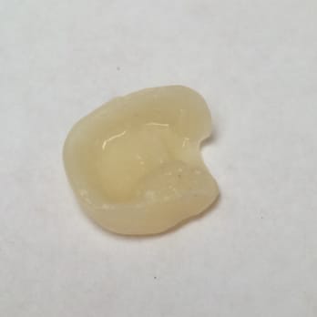 Cheng Dental - 7/8 crown provisional, check that beveled margin, work of art! - General Dentistry Near Me - San Gabriel, California Cheng Dental - 7/8 crown provisional, check that beveled margin, work of art! - General Dentistry Near Me - San Gabriel, California